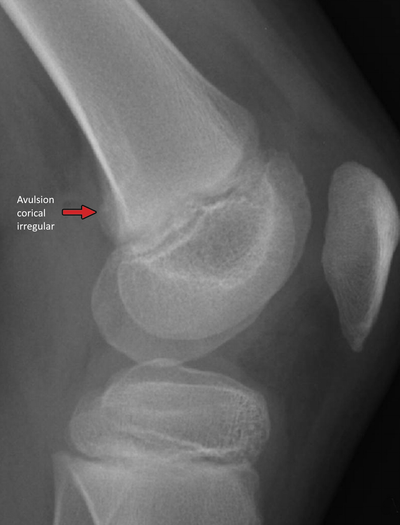 Radiografía de tumor desmoide periostal en fémur distal